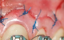 Cirugía endodontica 2.6