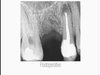 cirugía endodontica 2.5